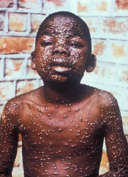 Coopération – Santé : L’Union Européenne accorde une aide financière à la RDC pour lutter contre la variole du singe