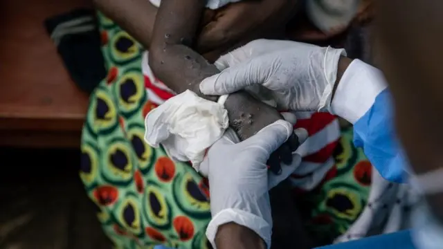 Mpox : Lancement de la campagne de vaccination le 2 octobre annoncé par Roger Kamba